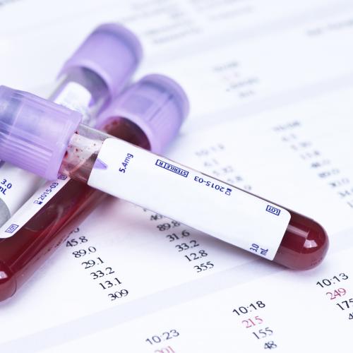 Hematology,blood,analysis,report,with,lavender,color,sample,collection,tubes.